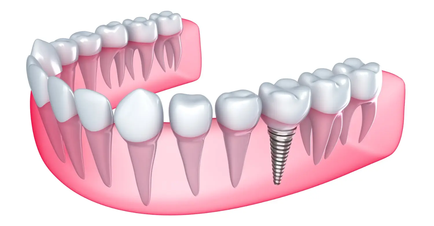 Single Tooth Implants 2